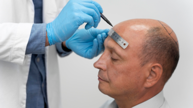 From Managing Alopecia to Planning a Hair Transplant: Restoring Full Hair Density
